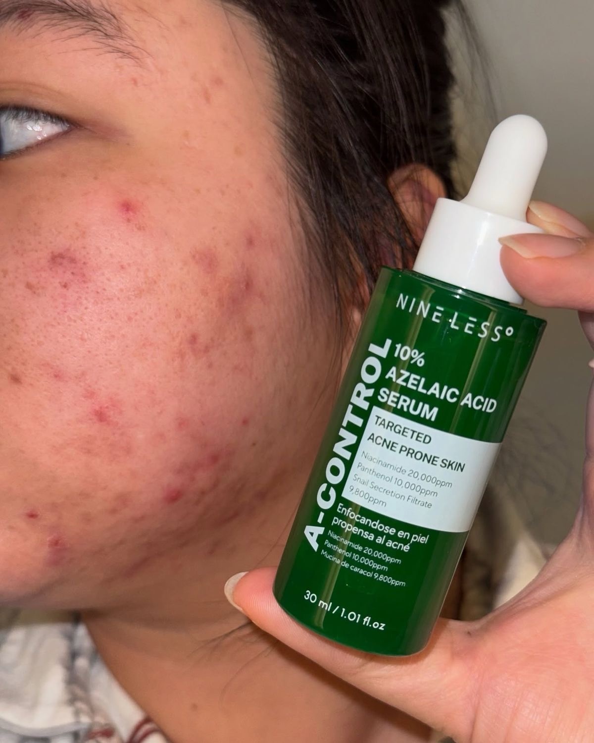 Nineless Essentials 10% Azelaic Acid Serum – Image 2